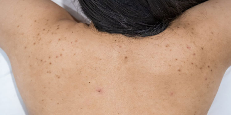 The Bane Of Acne: Scars